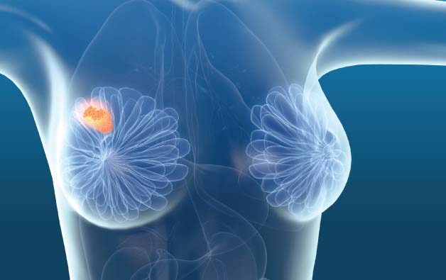 Breast Lump Removal Surgery (Lumpectomy) in Kolkata @ Low Cost